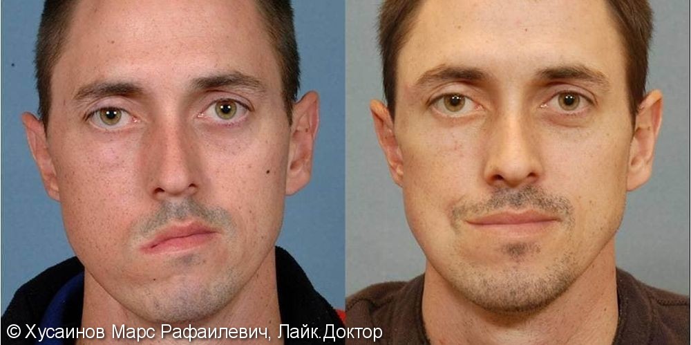 Сравнение: асимметрия лица и норма
